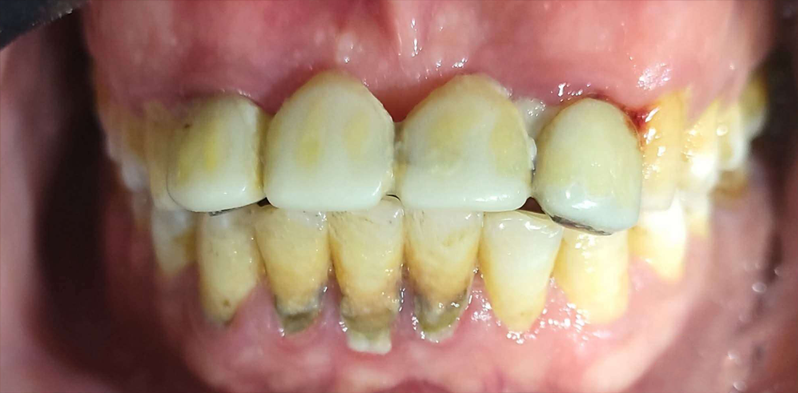 قبل — علاج تسوس طفل